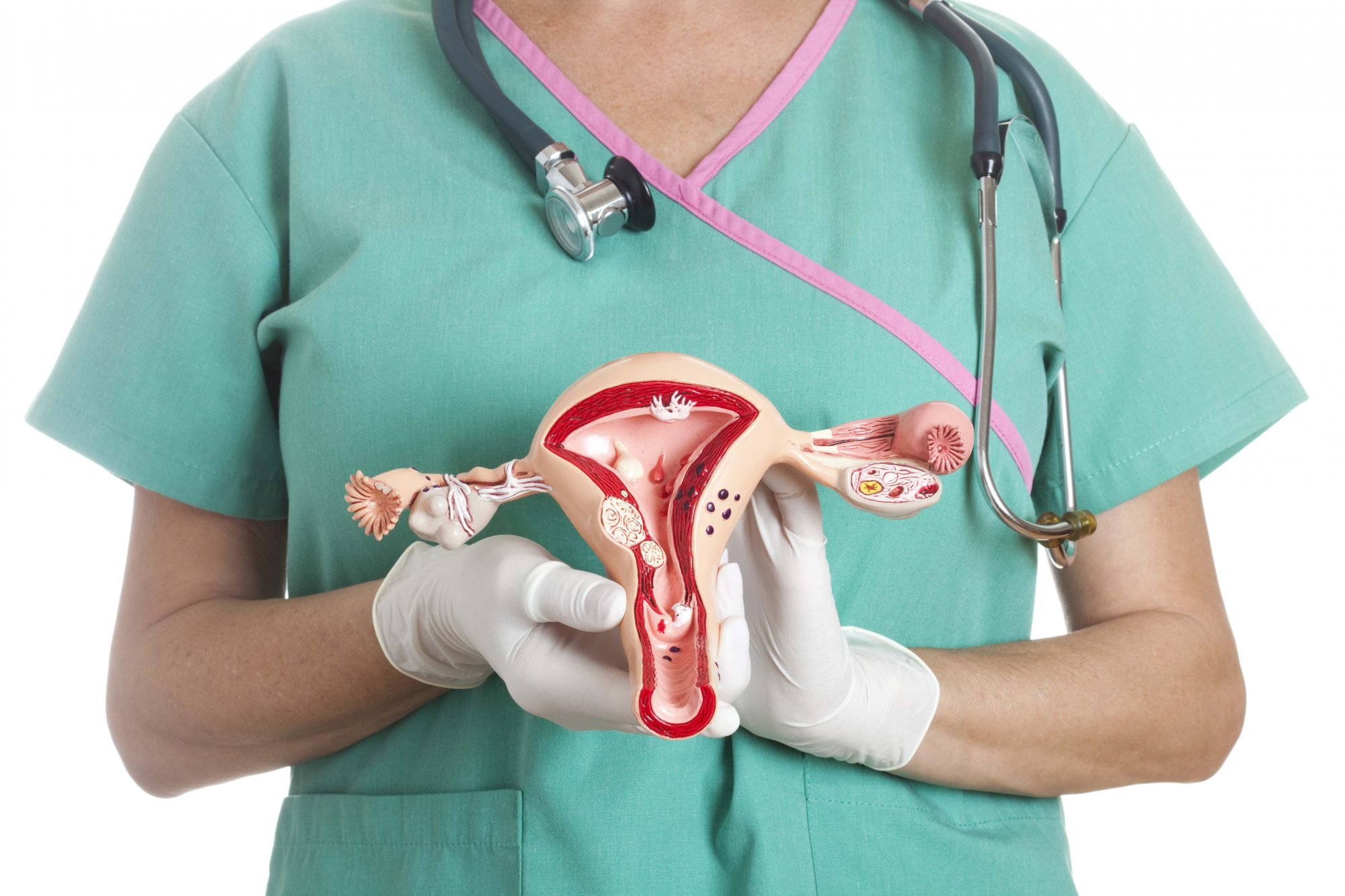 Pólipo endometrial
